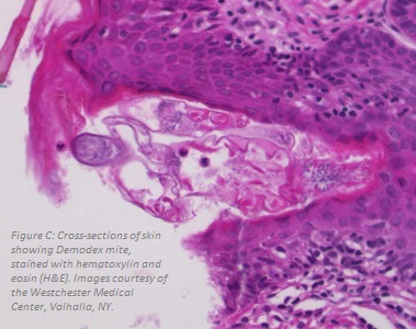 Can demodex mites trigger acne?