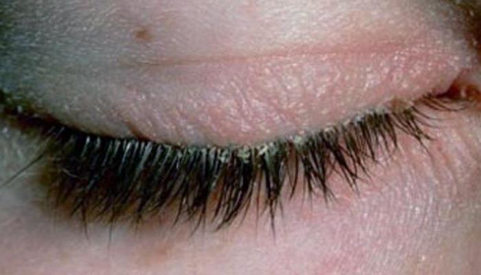 лечение демодекса глаз в домашних условиях